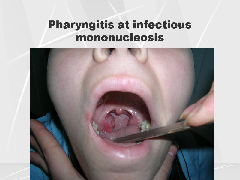 Pharyngitis at infectious mononucleosis